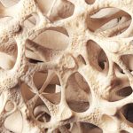 Osteoporoza – jak zapobiegać?